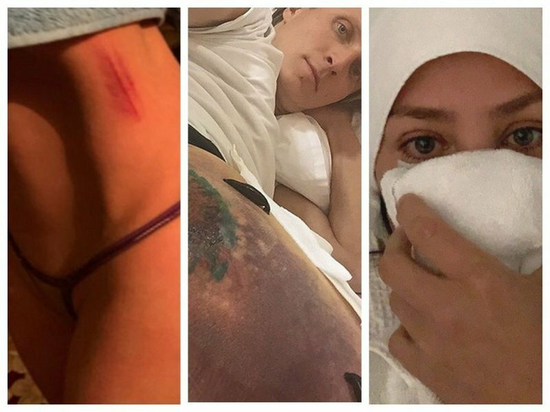 Травмы наших звезд в инстаграме (18 фото+видео)