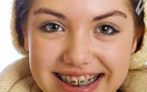 Niềng răng c&oacute; nhổ răng