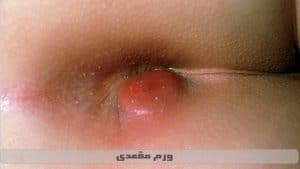 ورم مقعدی