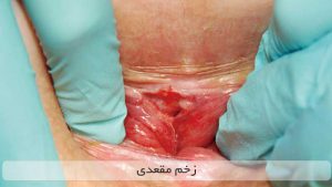 زخم مقعدی