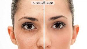 درمان زگیل صورت