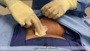 پانسمان کیست مویی