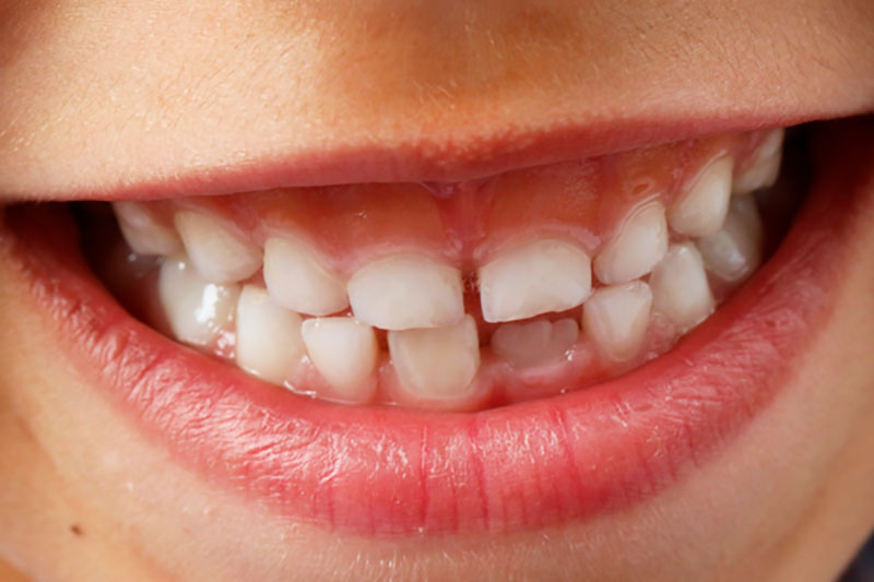 &iquest;C&oacute;mo nos salen los dientes?