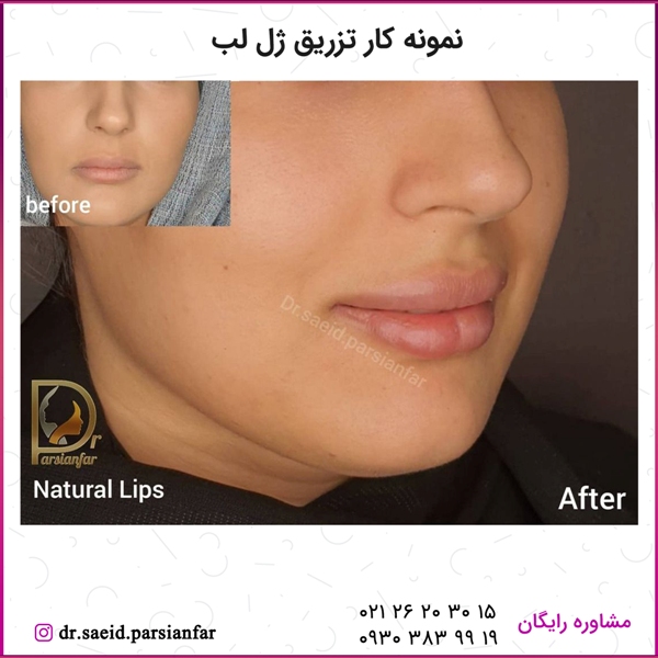 ژل لب نیمه فانتزی