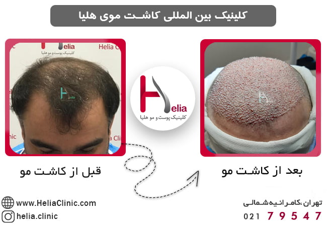 کاشت مو به روش میکروایمپلنت