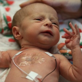 Logran reparar sin cirug&iacute;a un defecto arterial com&uacute;n en beb&eacute;s prematuros