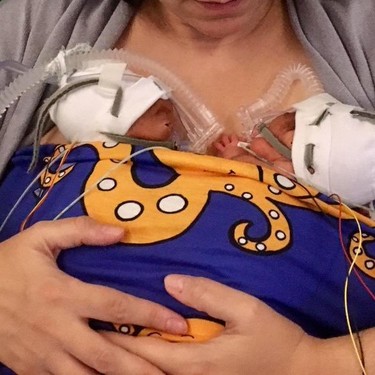 M&eacute;todo canguro: una enfermera crea una banda el&aacute;stica para favorecer el contacto piel con piel con el beb&eacute; prematuro