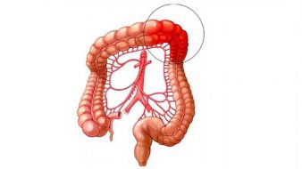 ایسکمی روده و انواع آن، علت، علائم، روش های تشخیص و درمان