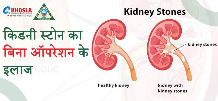 बिना सर्जरी के किडनी स्टोन का इलाज कैसे करें? जानिए विशेषज्ञों के सुझाव