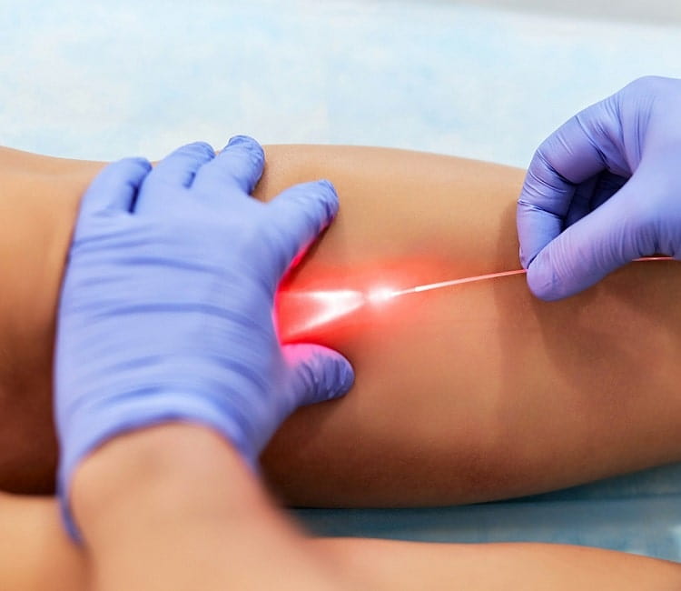 Ëàçåðíå ë³êóâàííÿ âàðèêîçíî¿ õâîðîáè âåí â Ñàìáîð³