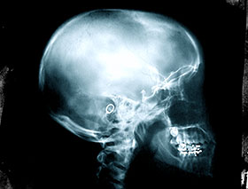 Discogram Back Pain Dallas Texas