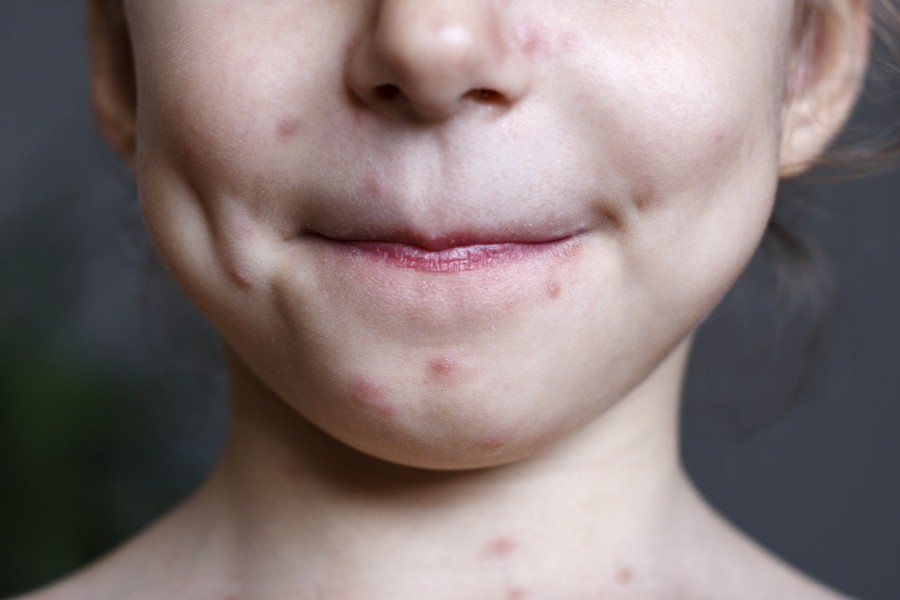 W jaki spos&oacute;b objawia się ospa?