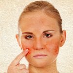 Home remedies for rosacea include turmeric paste and aloe vera gel.