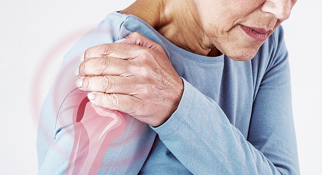 شانه یخ زده چیست