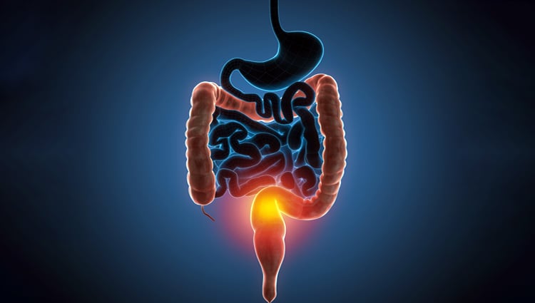 Retocolite ulcerativa