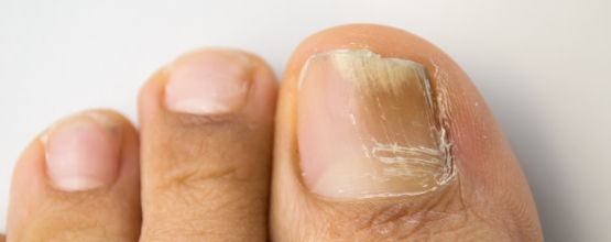 Toenail Fungus Treatment Options