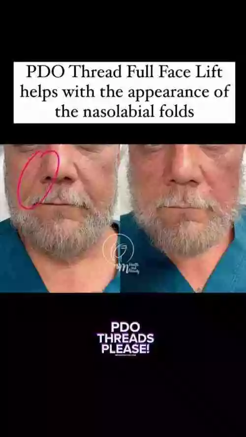 Look at the immediate results of a PDO Thread face lift and what it does to the nasolabial fold area!