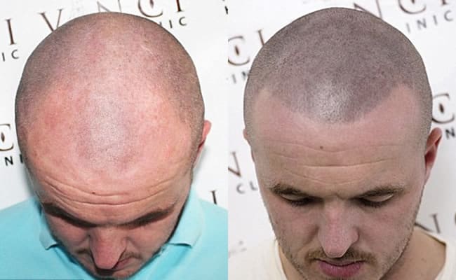 Bald Hair Tattoo Before and After