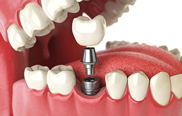 Image with missing alt attribute found on toothzone.com.au